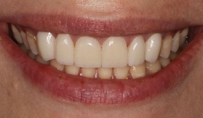 After Porcelain veneers on 6 front teeth