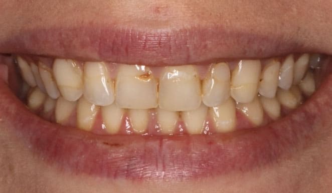 Before Porcelain veneers on 6 front teeth